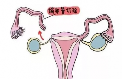南宁慈铭博鳌国际医院三代试管婴儿，切除双侧输卵管还能做试管婴儿吗？